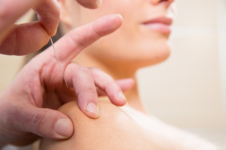 Image of a woman getting acupuncture