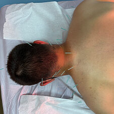 Image of a man getting acupuncture